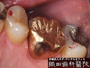 虫歯治療(修復、単冠補綴） - 織田歯科医院 ODA DENTAL OFFICE
